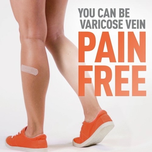 venaseal minimally non invasive varicose vein cure stop leg pain