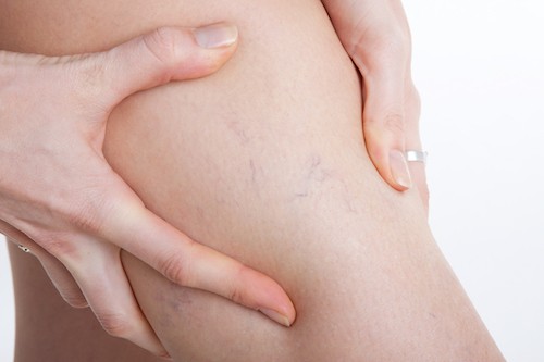 What Does Varicose Vein Leg Pain Feel Like?